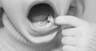 How Long Do Teeth Fillings Last?