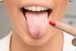 Oral Candidiasis Explained