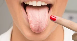 Oral Candidiasis Explained
